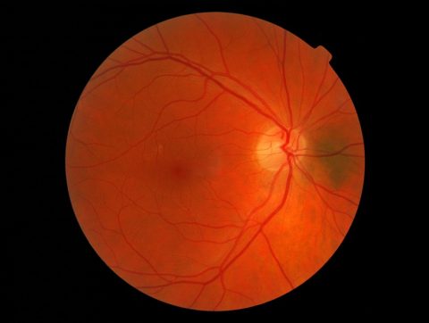 Diabète : Prévenir la cécité grâce à l&rsquo;IA