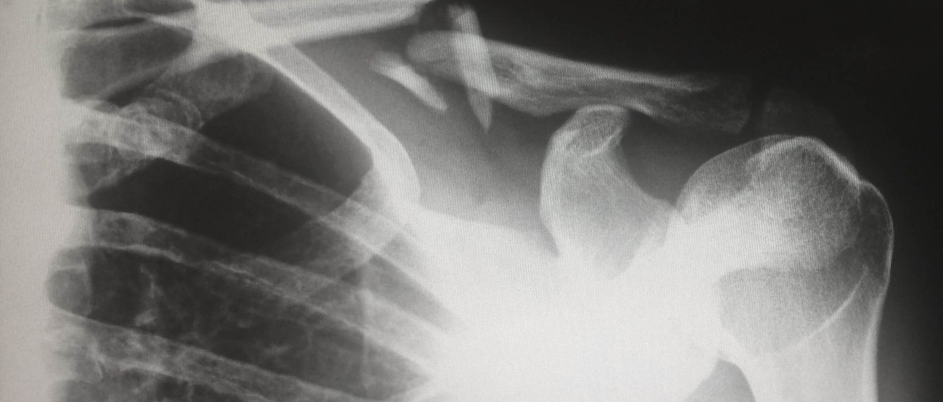 Mieux détecter les fractures sur des radiographies grâce à l&rsquo;IA