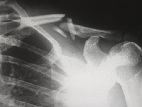 Mieux détecter les fractures sur des radiographies grâce à l&rsquo;IA