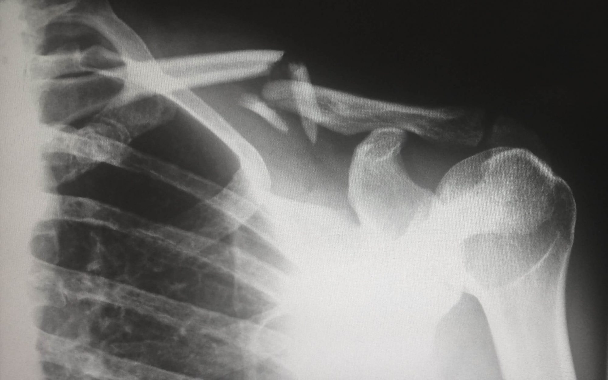 Mieux détecter les fractures sur des radiographies grâce à l&rsquo;IA